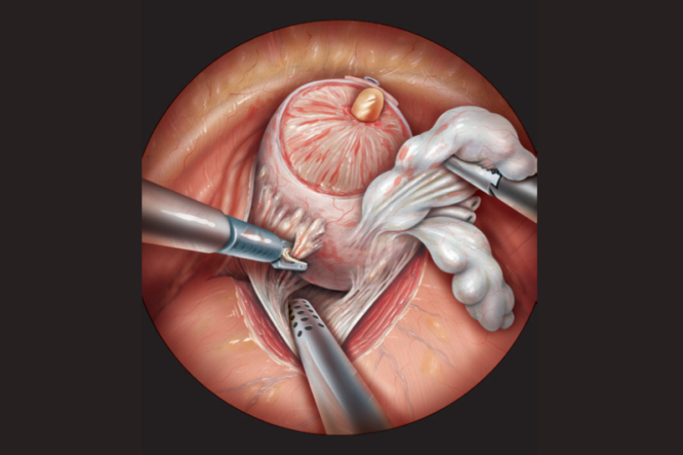 Como Funciona a Cirurgia Robótica para Câncer de Próstata?